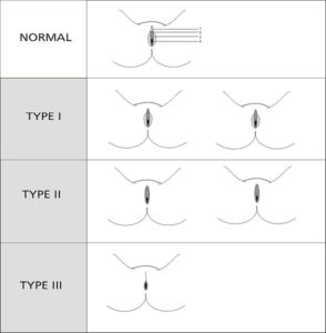 The three types of FGM.